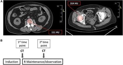 Anti-CD20-Mediated B Cell Depletion Is Associated With Bone Preservation in Lymphoma Patients and Bone Mass Increase in Mice